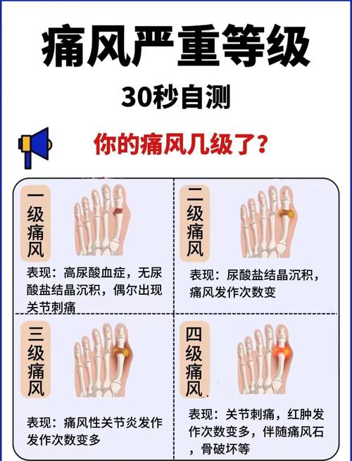 痛风悄悄找上门？怎么判断自己痛风了，这些信号别忽视！