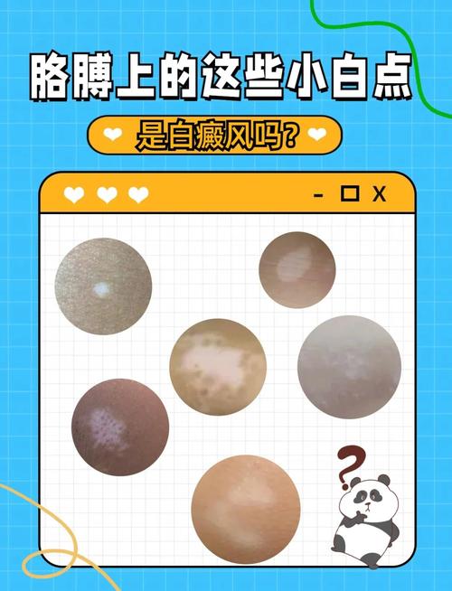 皮肤白斑是什么原因?揭秘让你惊讶的真相,快来看看你中招没!