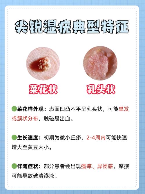 糟了！肛门长了小疙瘩？别慌，这可能是尖锐湿疣的征兆！