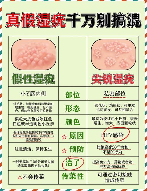 尖锐湿疣是性病么？别慌，3分钟带你认清真相！