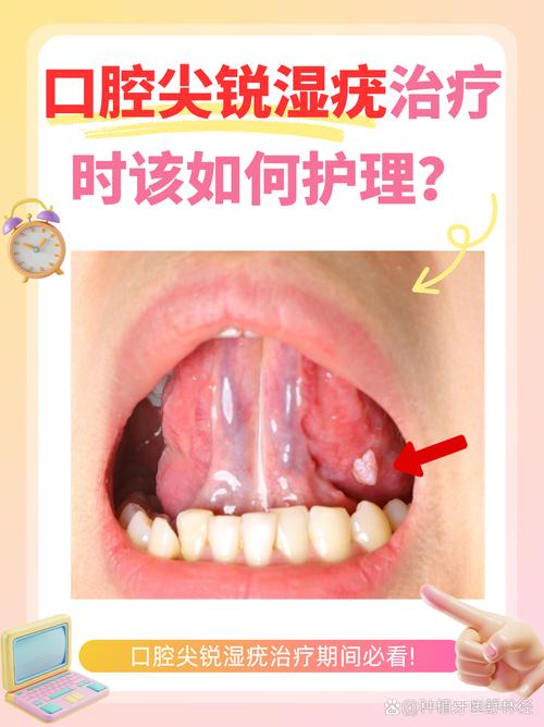 口腔尖锐湿疣怎么治疗?别慌!这份轻松有趣的治愈指南请收好