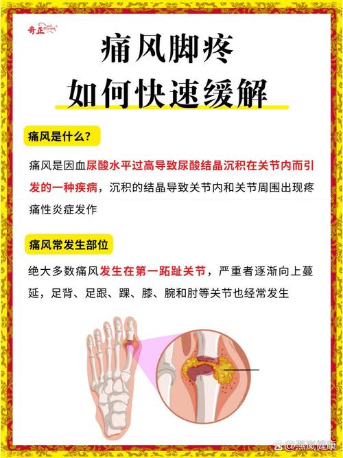 痛风消肿止痛最快方法！3招轻松缓解，让你立刻告别疼痛折磨