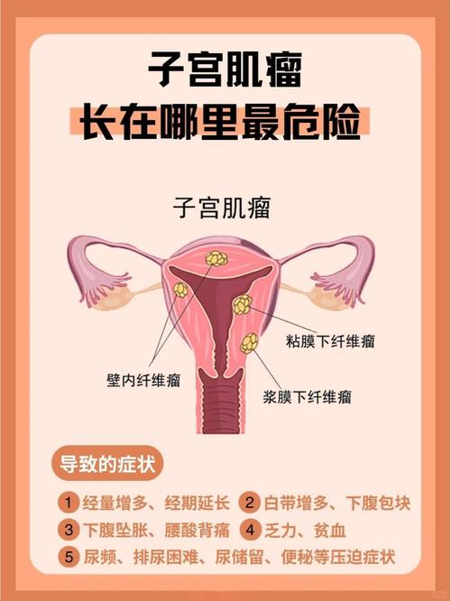 子宫肌瘤是什么原因导致的？这5个“元凶”你可能天天在接触！