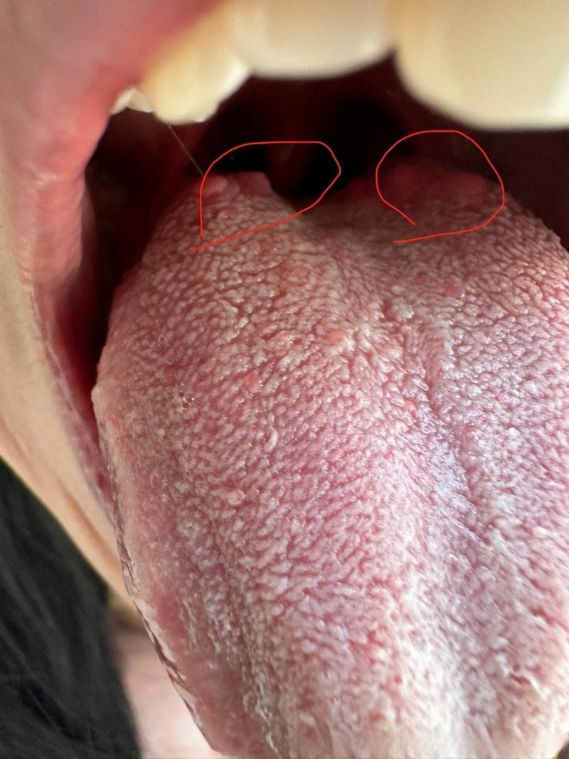 吓一跳！口腔尖锐湿疣图片曝光，这些“小疙瘩”千万别自己抠！