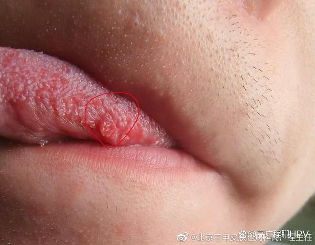吓一跳！口腔尖锐湿疣图片曝光，这些“小疙瘩”千万别自己抠！