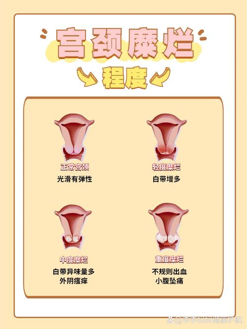 宫颈糜烂是什么原因造成的？这5个习惯你可能天天在做！