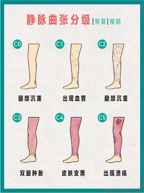 静脉曲张是什么原因引起的？再不注意这几点，你的腿就要抗议了！