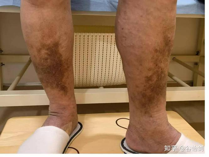 静脉曲张是什么原因引起的？再不注意这几点，你的腿就要抗议了！