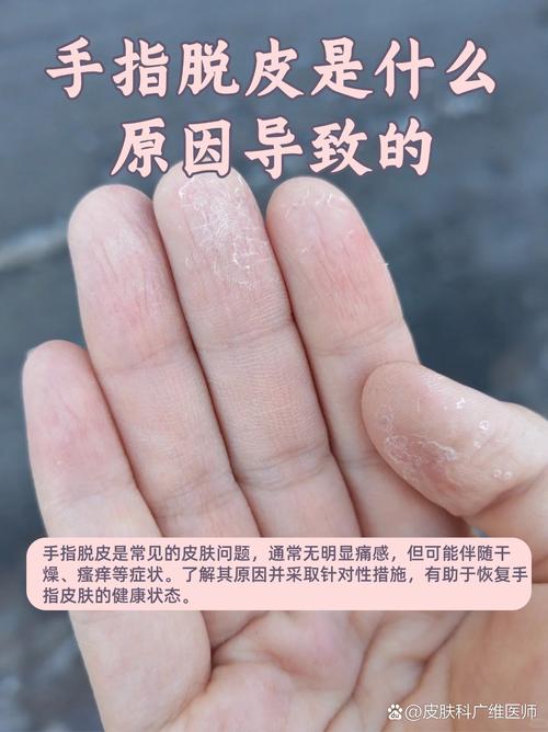 手脱皮是什么原因导致的?这5个常见元凶你可能天天在接触!
