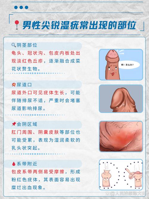 尖锐湿疣能根治吗？别慌！这份轻松除疣指南让你彻底告别尴尬