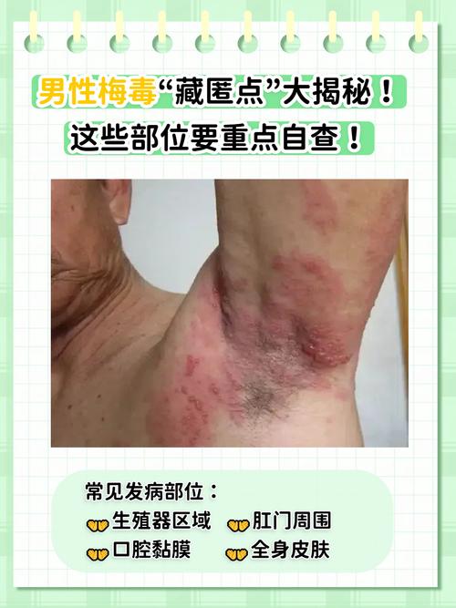 男性梅毒图片曝光!出现这些症状千万别拖,速看自查