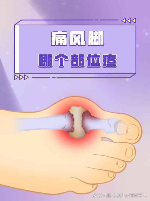 女人痛风先痛在哪里?别等脚趾剧痛才后悔!