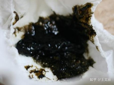 拉肚子拉黑色稀便什么原因？别慌！这几种情况要立刻警惕