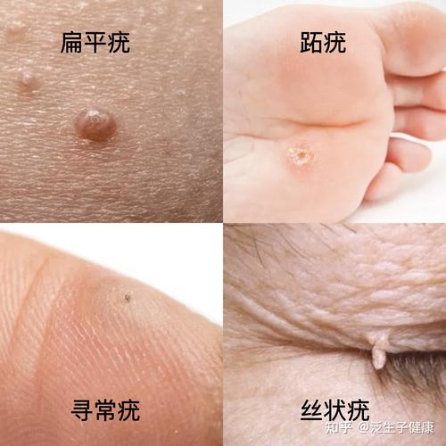 男性hpv感染图片曝光！这些触目惊心的症状千万别忽视