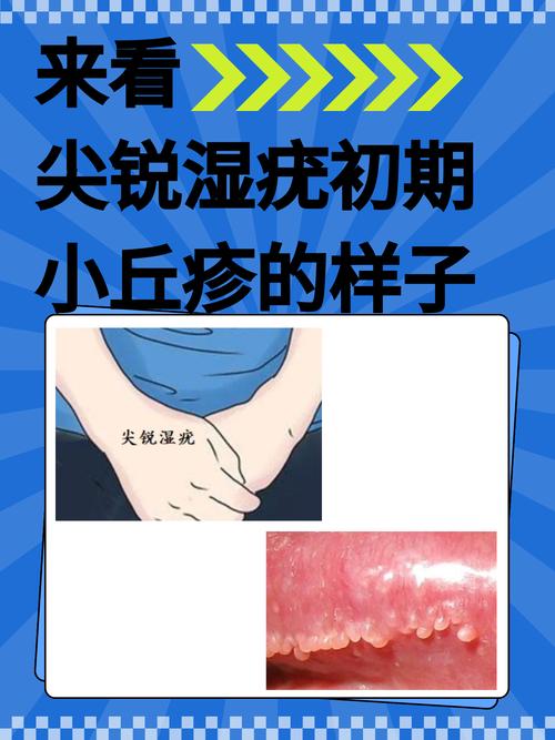 天呐！这些迹象要当心！医生亲授尖锐湿疣怎么检查出来的全过程