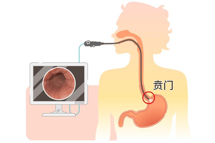 胃炎会拉肚子吗?别让肠胃“抗议”升级,3招教你紧急刹车!