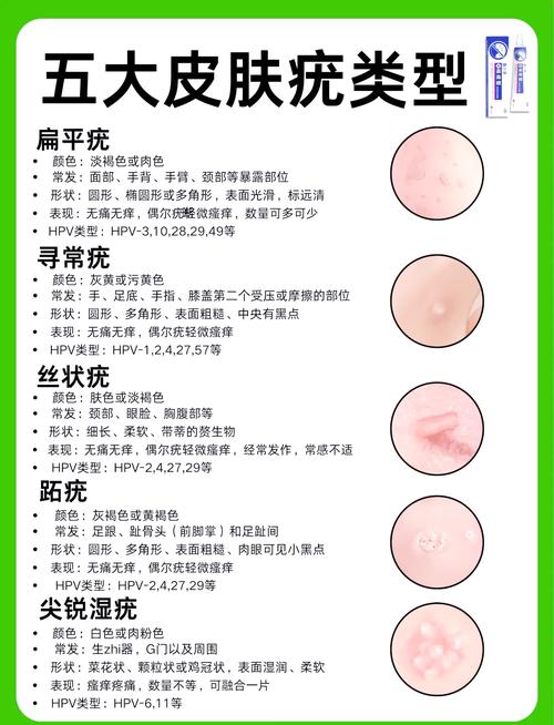 疣是什么原因造成的？揭秘皮肤上小疙瘩的幕后黑手！