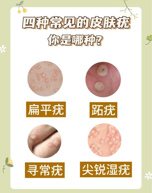 疣是什么原因造成的？揭秘皮肤上小疙瘩的幕后黑手！