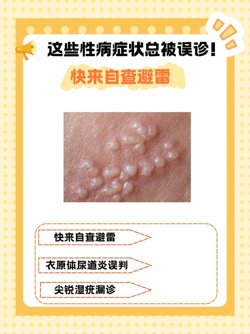 性病都有什么？这几种症状千万别忽视，现在知道还来得及！