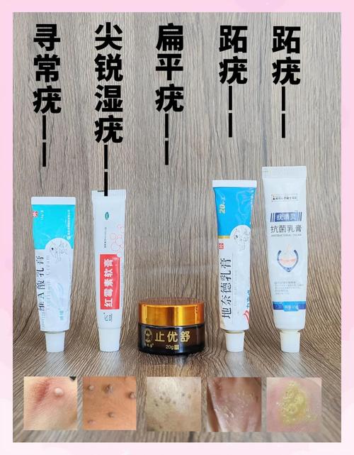 治疗尖锐湿疣的药膏有哪些？轻松搞懂如何正确选择与使用！