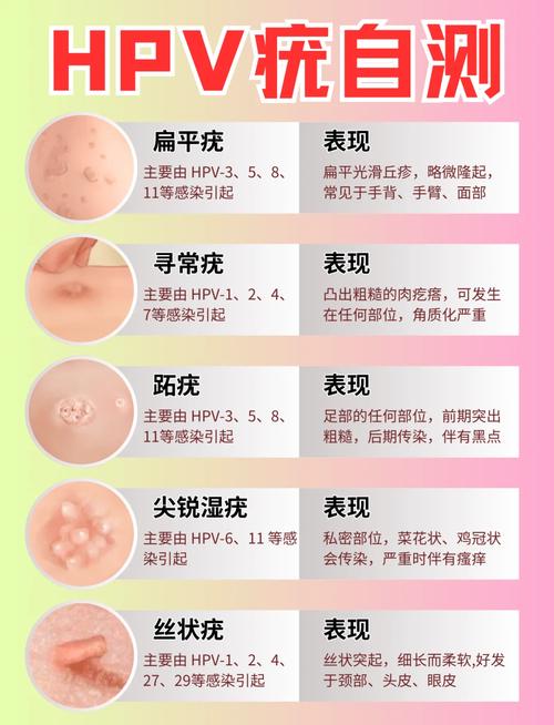 【真人图解】尖锐湿疣症状图片曝光!这5种