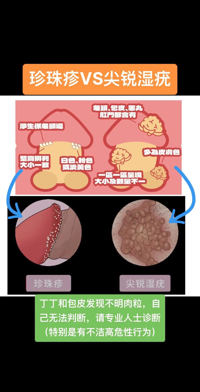 男性尖锐湿疣图片曝光！这些“小疙瘩”千万别自己乱处理