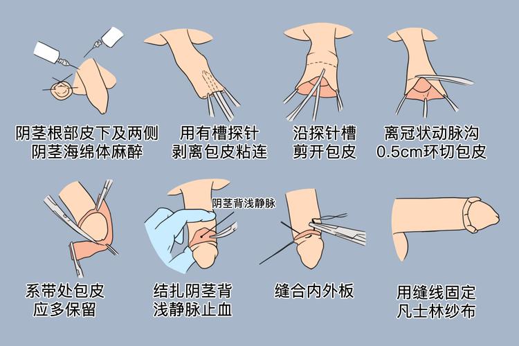 包皮过长手术图片全解析：轻松了解过程，告别手术恐惧！