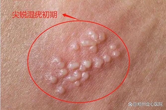 男性湿锐疣早期图片曝光！3分钟自检，这些细节千万别忽视