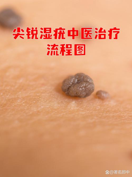 中医尖锐湿疣怎么办?老中医教你轻松应对,告别难言之隐!