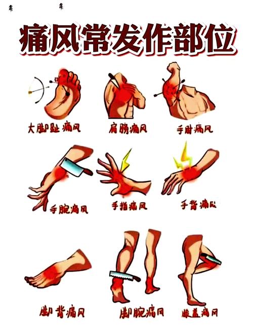 痛风会在哪些部位痛？这5个地方最容易被盯上，快看看你中招没！