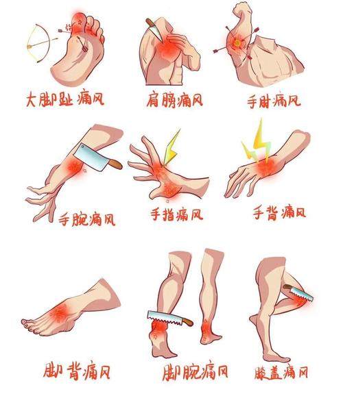 痛风会在哪些部位痛?这5个地方最容易被盯上,快看看你中招没!
