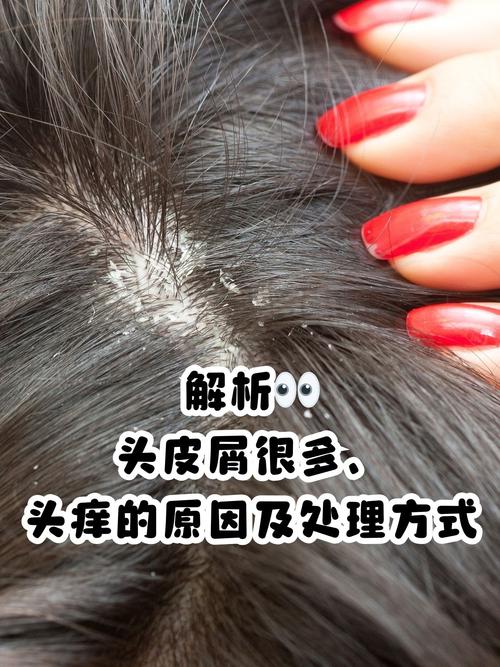 头皮屑特别多是什么原因?5个坏习惯让你秒变“雪花头”!