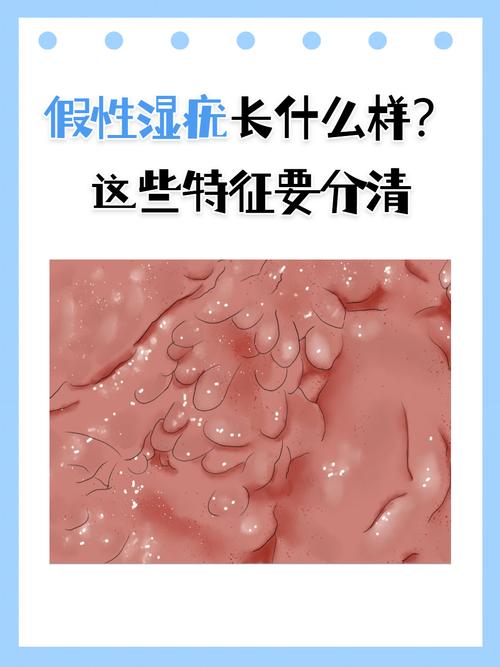 假尖锐湿疣是什么?别慌!你可能只是虚惊一场