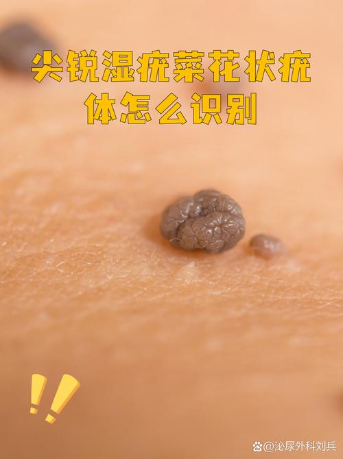 菜花状疣图片男性必看!轻松辨别与应对,别让尴尬找上门