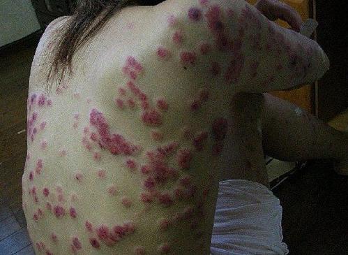 警惕！男性早期梅毒图片曝光，这些皮肤异样千万别当成普通痘痘！