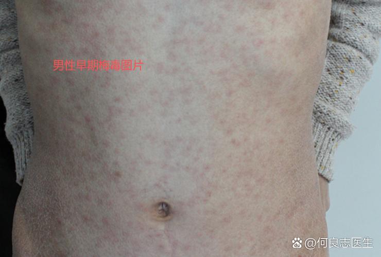 警惕!男性早期梅毒图片曝光,这些皮肤异样千万别当成普通痘痘!