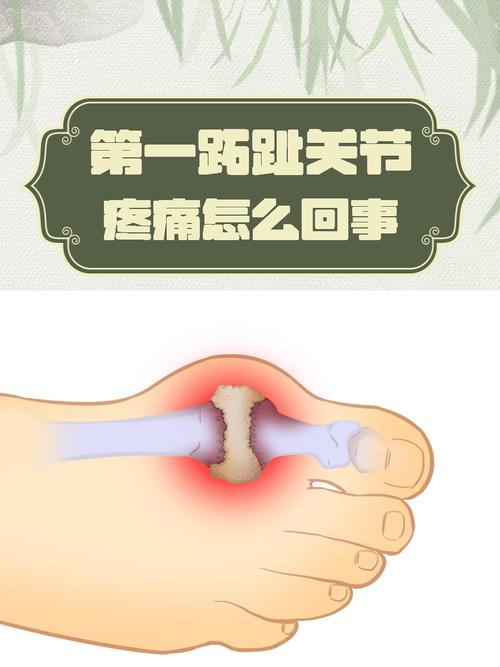 痛风一般是哪个脚趾疼？别猜了，这个脚趾一疼就要警惕！