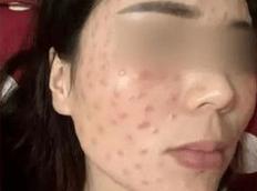 水光针的副作用和危害你知道吗？这几点不注意小心“美容”变“毁容”！