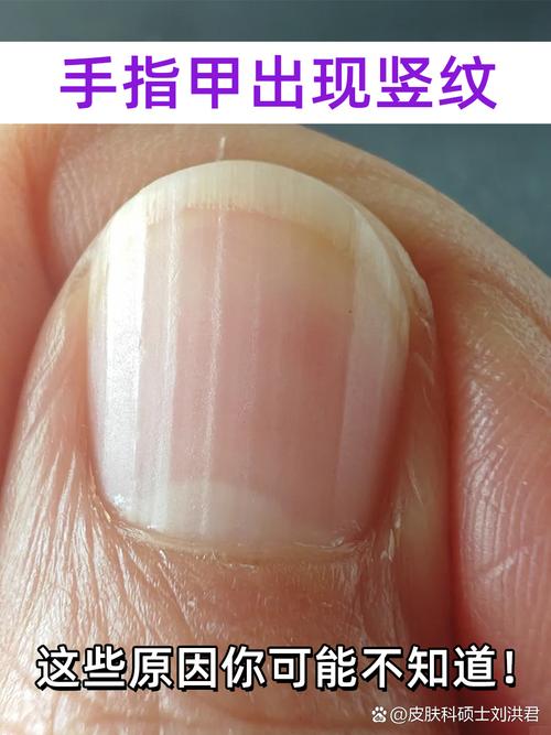 指甲有竖条纹是什么原因？别慌！这几种情况你该知道