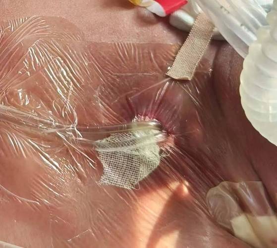 微创人流真的无痛又安全吗？专家揭秘手术全过程与术后恢复要点