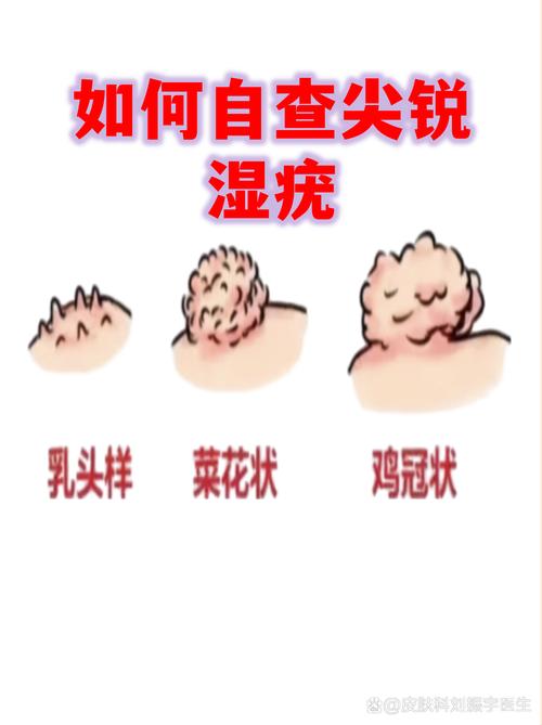 男性尖锐湿疣初期图片曝光！3分钟轻松自检，别让尴尬拖成大病