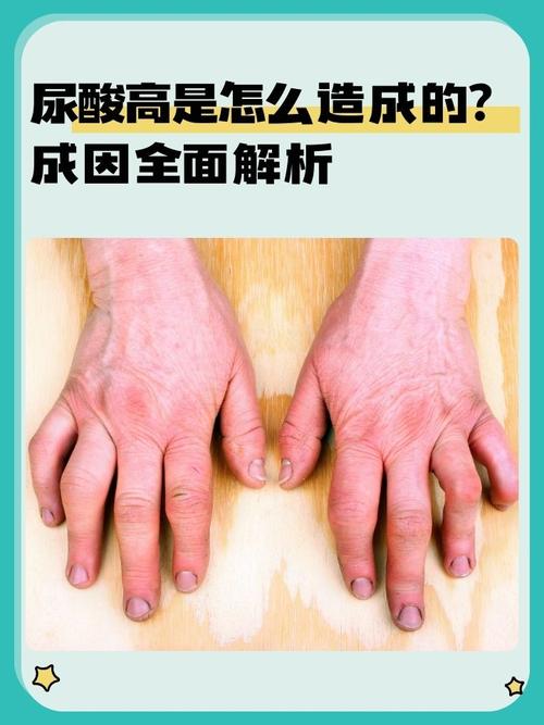 男性尿酸高有哪些症状?这5个身体信号千万别忽视!