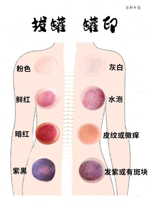 经期能拔罐吗？这几点不注意，小心气血两亏！