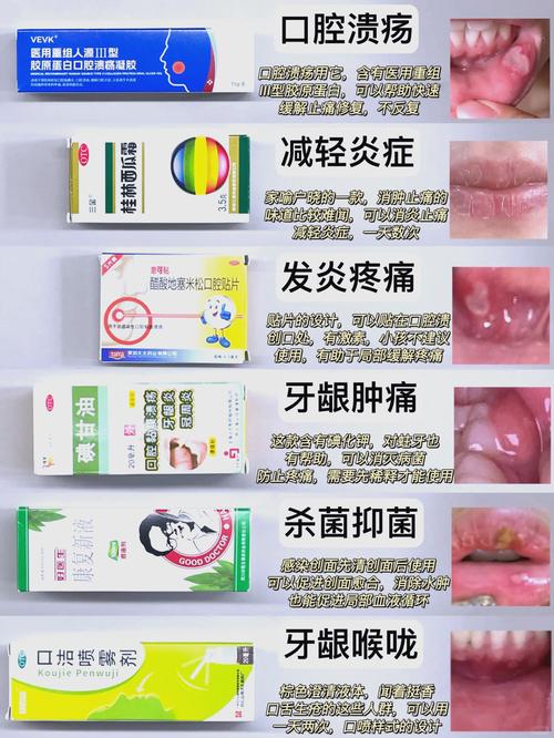 口腔溃疡吃什么药最管用？专家教你快速止痛愈合的小妙招！