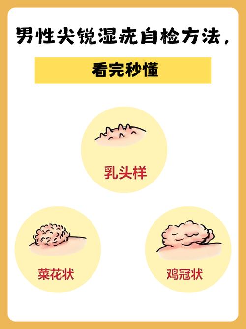 检查尖锐湿疣是怎么检查？别慌！这份轻松易懂的检查指南请收好