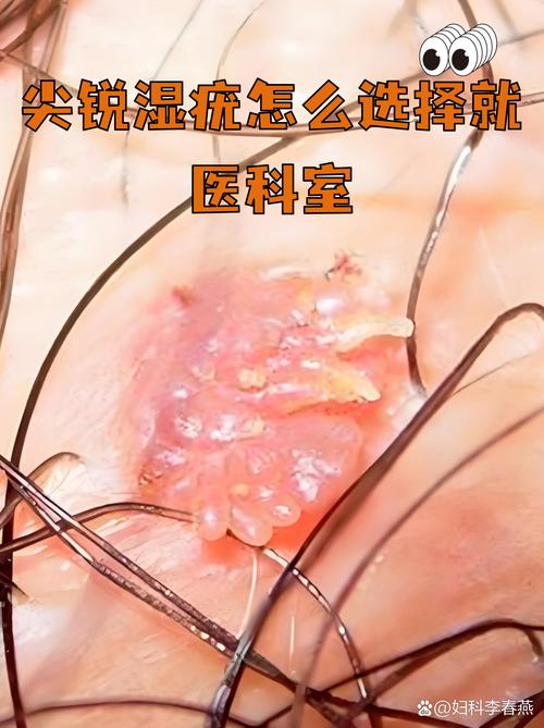 尖锐湿疣挂什么科?别犹豫,选对科室是康复的第一步!