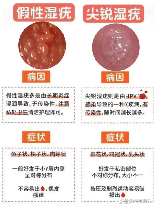 尖锐湿疣是什么症状？别慌！这8个典型表现一看就懂，现在自查还来得及