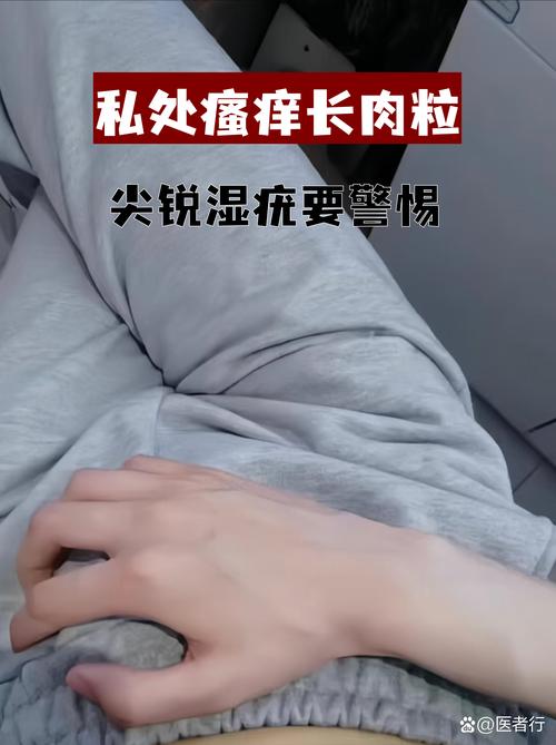 尖锐湿疣会不会痒？医生揭秘：这种“痒”千万别乱挠，小心越挠越多！