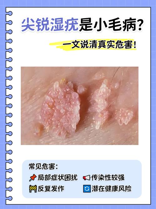 尖锐湿疣危害有多大?别让这些“小疙瘩”悄悄毁掉你的健康与幸福!