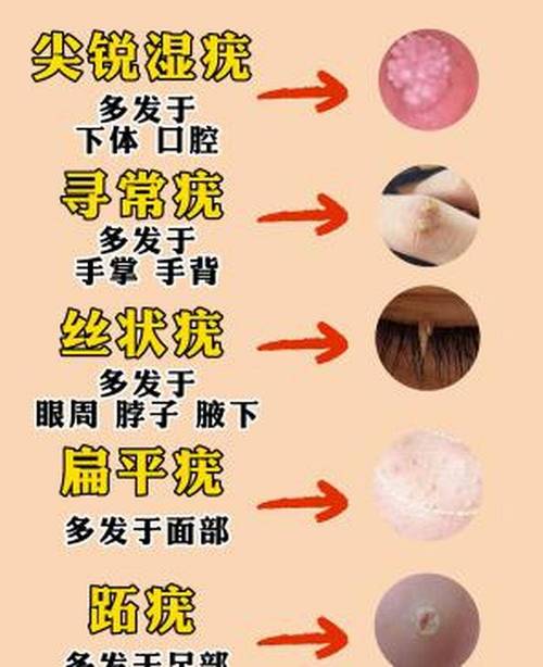 警惕！尖锐湿疣分泌物出现这些变化，可能是身体在“拉警报”